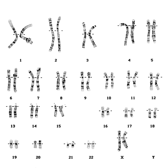 cariotipo delecin cromosoma 16