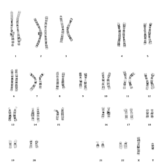 cariotipo con delecin en cromosoma 7