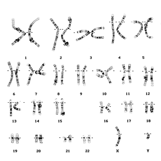 cariotipo inversin del cromosoma 10